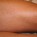 Urticaria Pigmentosa